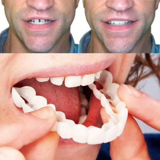 Realistic Dental Veeners - Upper & Lower Teeth, Natural Look & Whitening