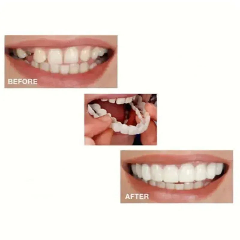 Realistic Dental Veeners - Upper & Lower Teeth, Natural Look & Whitening - Trendsters Pk